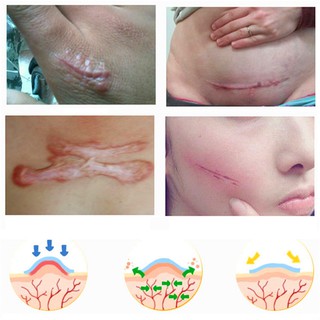 【RE】1x Silicone Scar Removal Patch to Remove Trauma Burn Scar Sheet Skin Repair