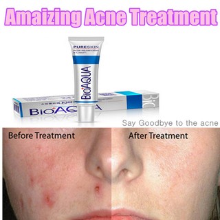 BIOAQUA Skin Care Acne Treatment Scars Cream Anti Acne