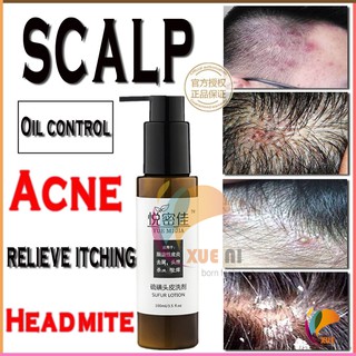 Scalp folliculitis Red and swollen acne Anti-dandruff and antiitchy Mite shampoo (1)